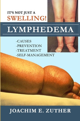 It's Not Just a Swelling! Lymphedema: Causes, Prevention, Treatment, Self-Management by Joachim Zuther book cover
